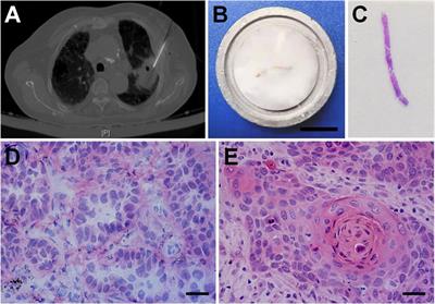 Comparison of Multi-Gene Testing Data Between Fresh and Formalin-Fixed Specimens From Core Needle Biopsy in Patients With NSCLC